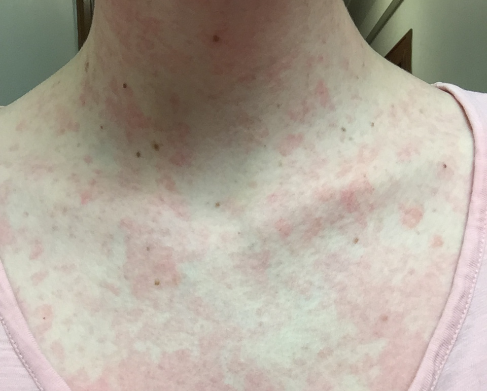 close-up-of-woman's-collarbone-area-with-blotchy-red-rash