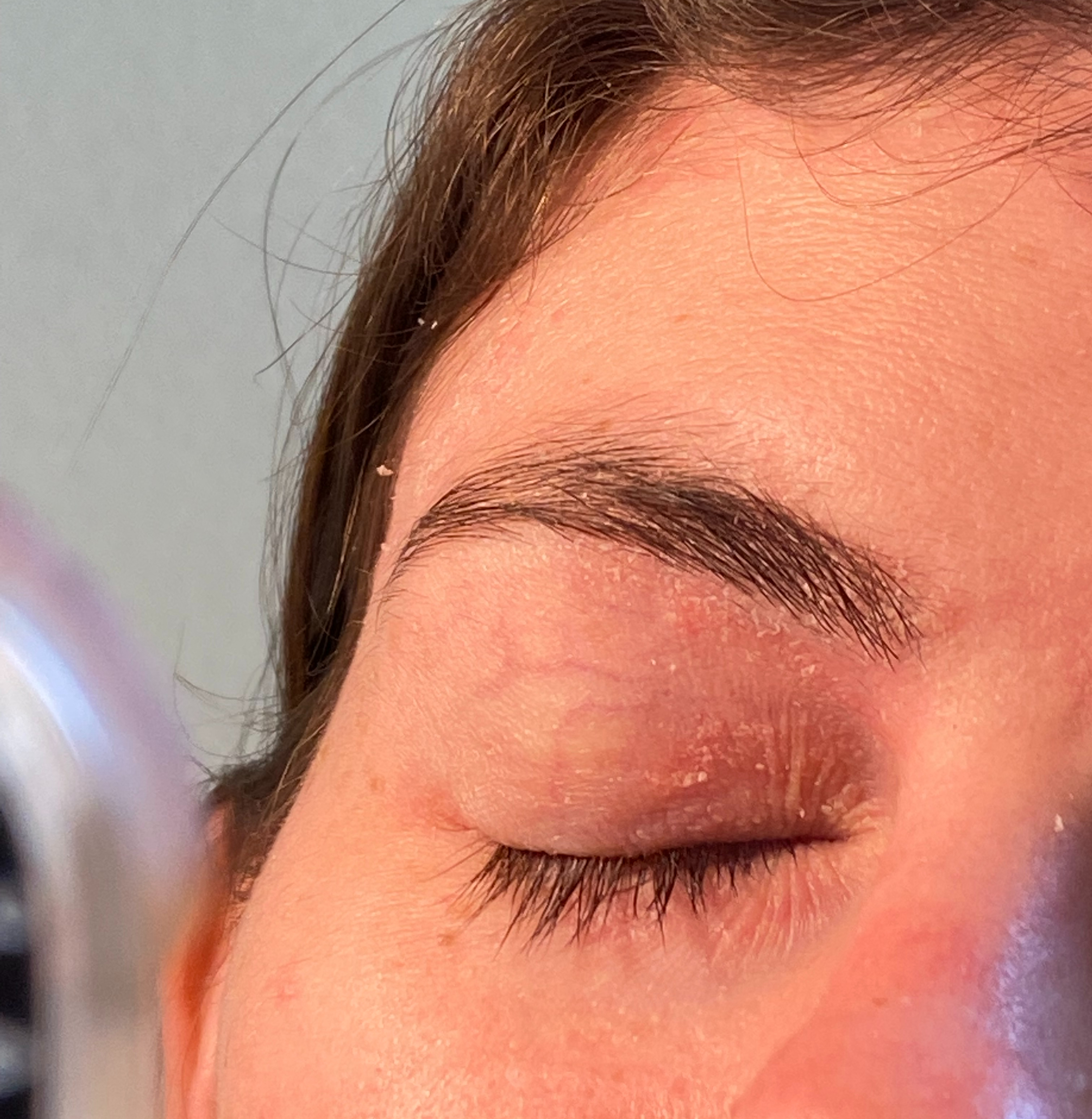 A person's closed eye with red psoriasis on the eyelid