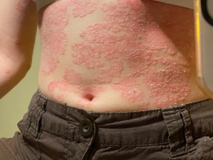 A person's torso with large psoriasis plaques.