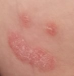 A psoriasis plaque that looks like a smiley face
